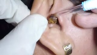 Woman's Massive  Earwax Removal in Both Ears