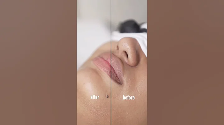 Get Pink Lips Fast: Carbon Laser Toning for Dark, Pigmented Lips! 💋✨ #PinkLips #darklipstreatment