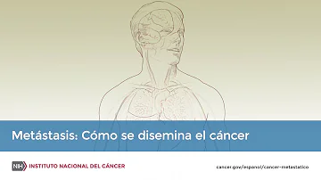 ¿Cómo se siente con un melanoma metastásico?