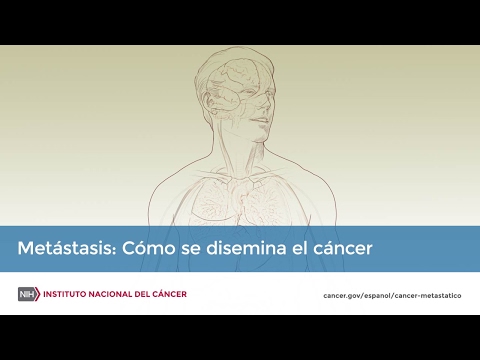 Metástasis: Cómo se disemina el cáncer
