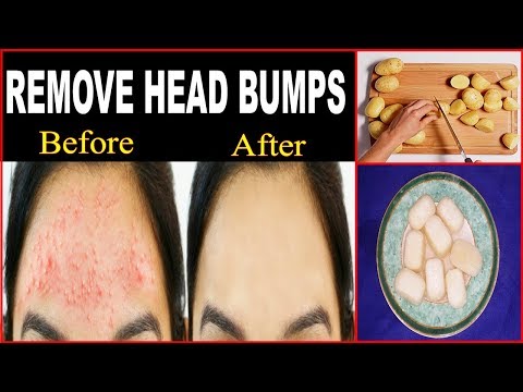 Remove Forehead Bumps, Pimples and Acne Permanently - % Works - Summer Care Tips in Urdu