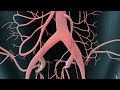 Abdominal Aortic Aneurysm