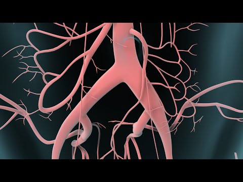 Video: Abdominal Aortaaneurysm - Symtom, Behandling, Kirurgi, Bristning