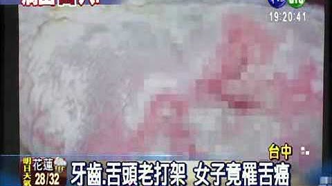 老是咬到舌 尖牙恐致舌癌 - 天天要聞