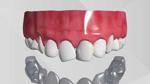 Invisalign 3D Animation