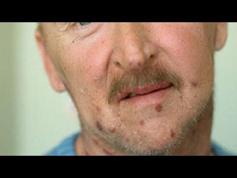 Sintomas Mais Comuns Do HIV Em Homens