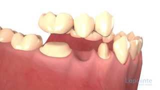 Dental bridges types  Lapointe dental centres