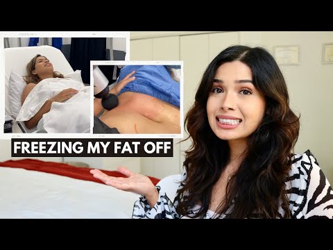 My COOLSCULPTING Experience | Is It Worth It? Before & After Results