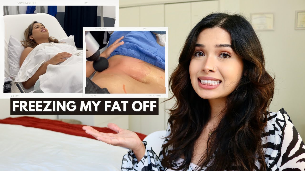 My Coolsculpting Experience | Is It Worth It? Before \U0026 After Results