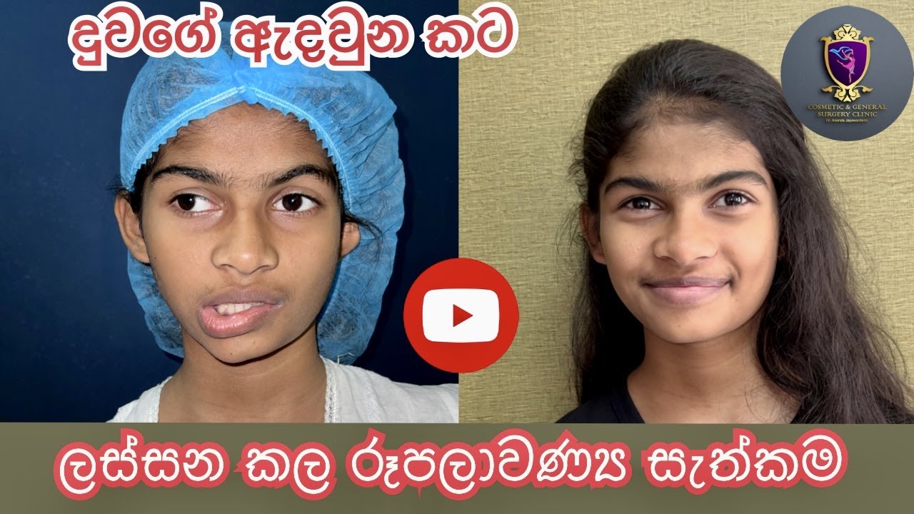 කට ලස්සන කල රූපලාවන්‍ය සැත්කම Mouth deviation in Beautiful girl Plastic