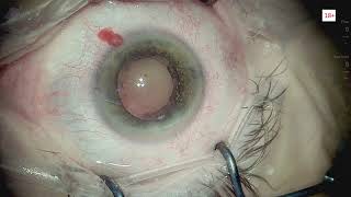 Ophthalmic Surgery Live 18 Lukan Mishev