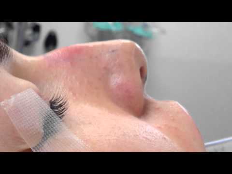 Video thumbnail: HumpBulbousTipRhinoplastyDrJoseph · Eric M. Joseph, M.D.
