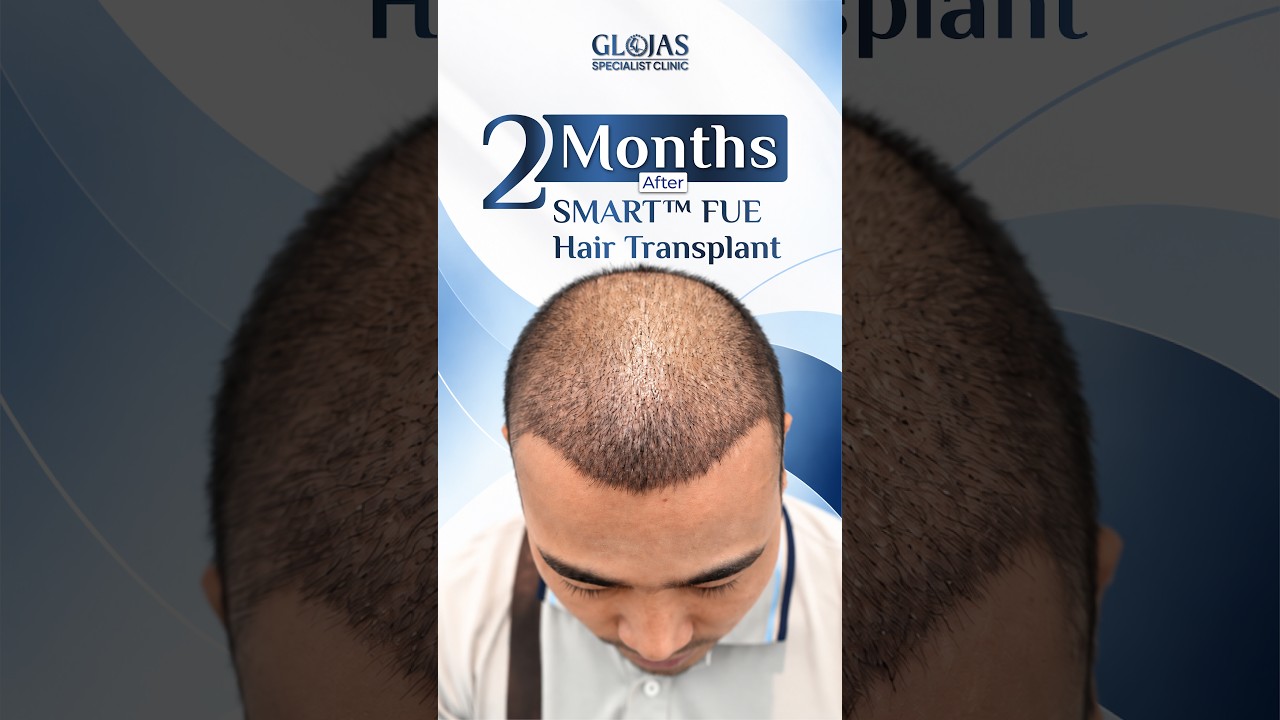 Our Doctors 15 Hair Transplant Malaysia l Hasil tanam rambut selepas 2 bulan! ✂️🌱 #hairtransplantmalaysia