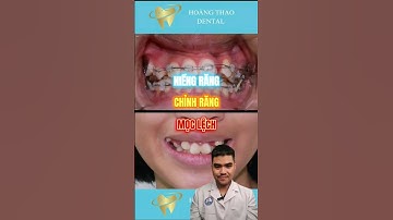 Niềng răng chỉnh răng mọc lệch #nhakhoa #shorts #bacsithao #chinhnha