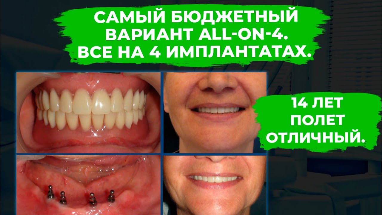 Самый бюджетный вариант All-ON-4. Все на 4 имплантатах. 14 лет — полет отличный.