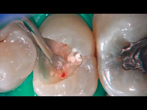 Video: Hvor længe varer en pulpektomi?