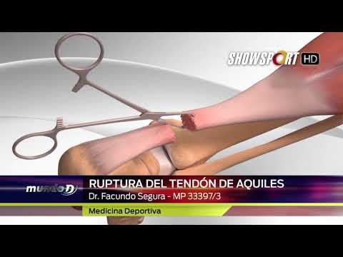 DR SEGURA RUPTURA TENDON