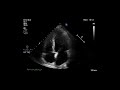 Cardiac ultrasonogram showing apical 4 chamber view