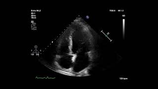 Cardiac Ultrasonogram Showing Apical 4 Chamber View