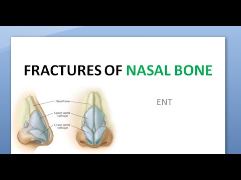 Video: Nasefraktur Med Og Uden Forskydning - Tegn, Førstehjælp, Konsekvenser Og Behandling Af Næsefraktur