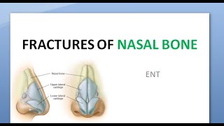 ENT Nasal Bone Fracture Depressed Angulated Treatment Nose Hit middle third face trauma