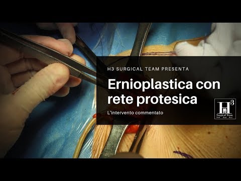 Video: Cronologia Dei Benefici, Dei Rischi E Dei Tempi Per La Chirurgia Addominale Di Adesiolisi