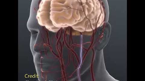 Can Thiệp Túi Phình Mạch Máu Não