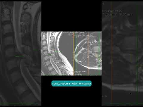 Грыжа Шейного Отдела Позвоночника 11 Мм. Разбор Мрт Пациента