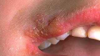 Home Remedies For A Cold Sore | Cold Sores On Nose | Cold Sore On Chin | Baby Cold Sore