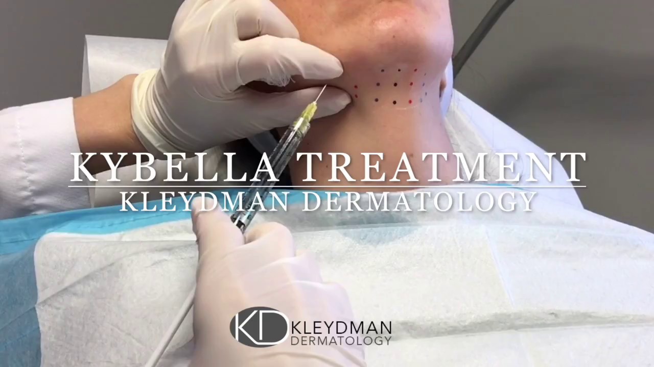 kybella-treatment-youtube