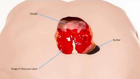 'Stan' Stage IV Pressure Ulcer Model™ - DayDayNews