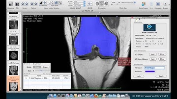 Semi-Automatic Segmentation in Osirix