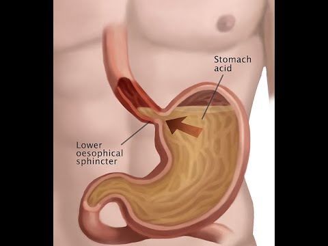 Diseases of the esophagus part 2 by ASM Minds Team