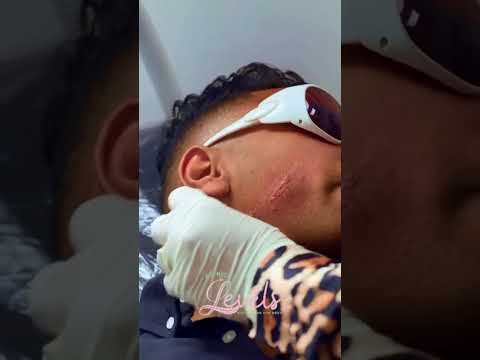 جلسة لإزالة آثار الجروح والتصبغات باستخدام جهاز الفراكشنال ليزر