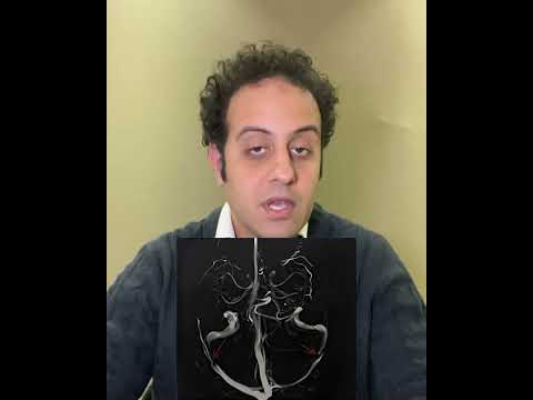 طنين الاذن النابض و تشخيص ضيق و اتساع اوردة المخ المسببه للطنين
