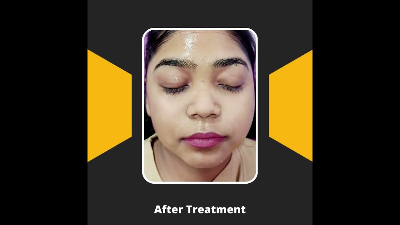 Best black doll carbon laser treatment