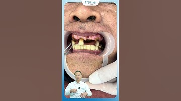 Hậu Quả Không Chăm Sóc Răng Miệng | Bác Sĩ Yên