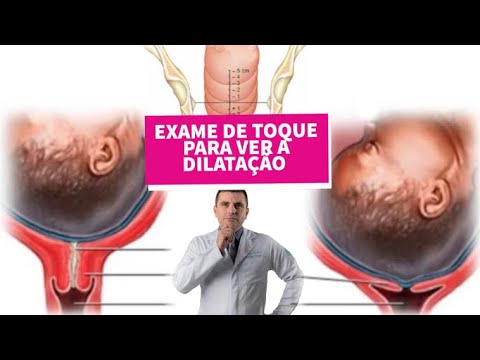 Vídeo: Como verificar um colo do útero para dilatação: 15 etapas (com imagens)