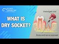 What is Dry Socket? Top dentist says how to Prevent It! | Atlanta Dental Spa (2019)
