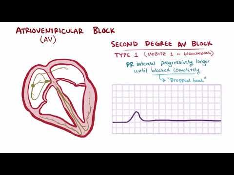 Video: Hvad er infranodal blokering?