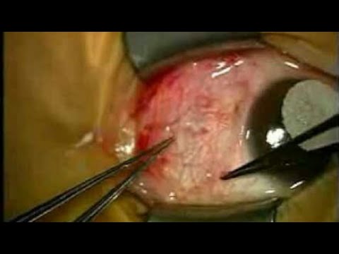 Pinguecula | Cirurgia pinguecula | Tudo sobre pinguecula