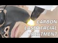 Can This Carbon Laser Facial Treat Melasma? Carbon Laser Peel (How It Works)