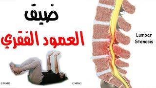 علاج ضيق العمود الفقري | تمارين لعلاج ضيق الفقرات القطنية - Lumbar Stenosis