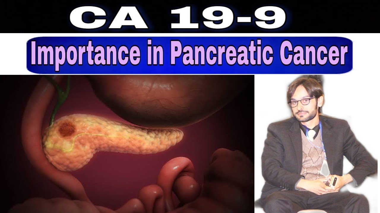 CA 19-9 Test || Pancreatic Cancer Screening - YouTube
