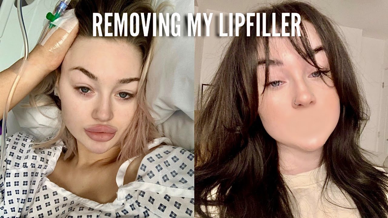 FINALLY GETTING MY LIPS DISSOLVED! YouTube FINALLY GETTING MY LIPS DISSOLVED! YouTube