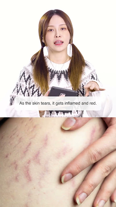 Do Stretch Marks Ever Go Away?