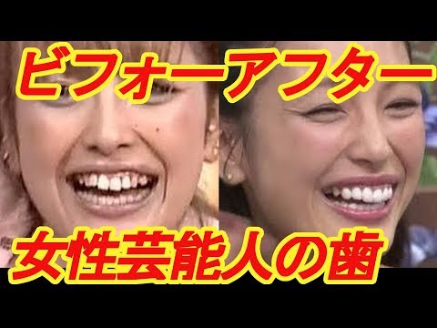 安室奈美恵も？！こんなに変わる！歯並びが綺麗に整った女性芸能人ビフォーアフター　【芸能デスク】before→after