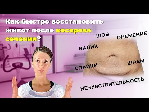 Как накачать пресс после кесарева сечения в домашних условиях