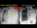 Pleural Effusion Cat X Ray