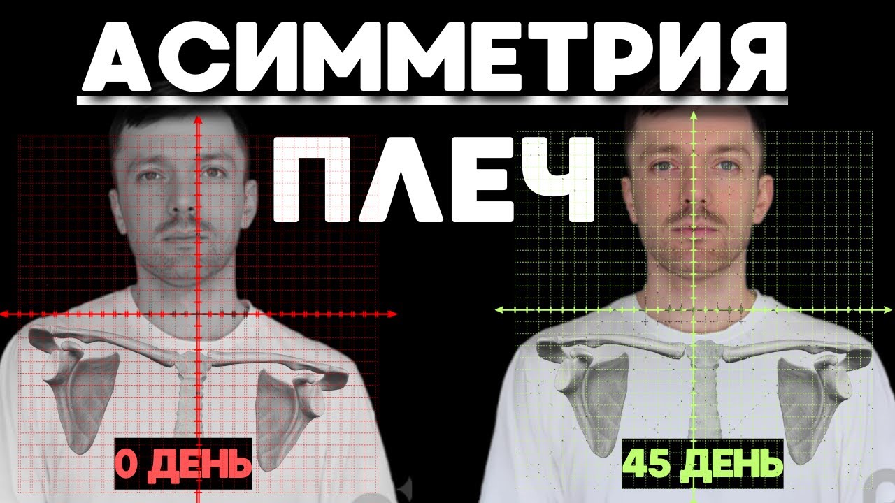 Одно плечо выше? Полное руководство от Б до Ю по выравниванию плеч